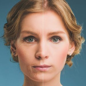 Botox Facial