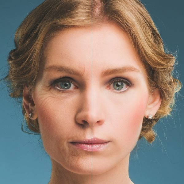 Botox Facial